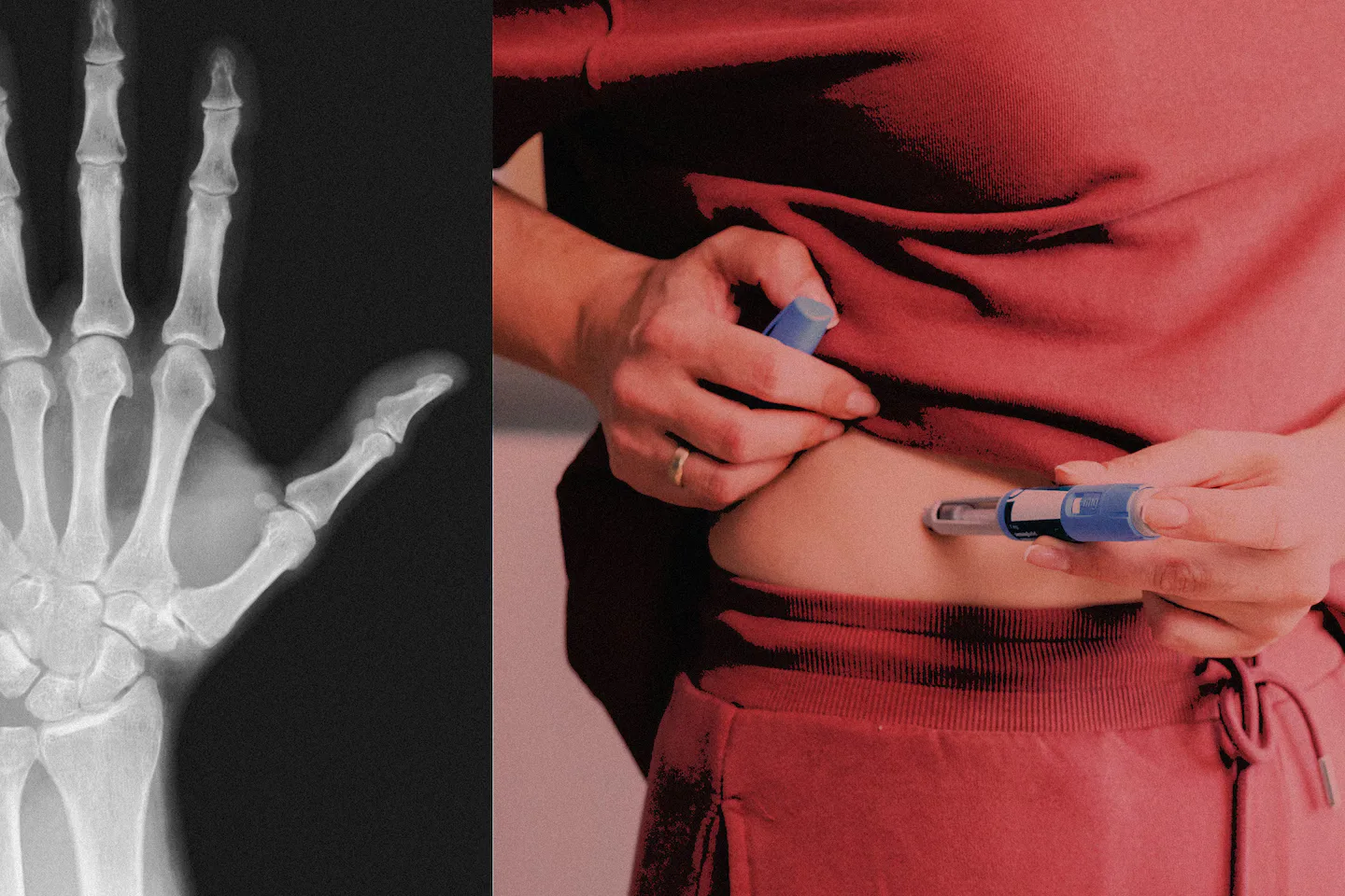 Leki GLP-1 jak Ozempic zwiększają ryzyko urazów kości i ścięgien