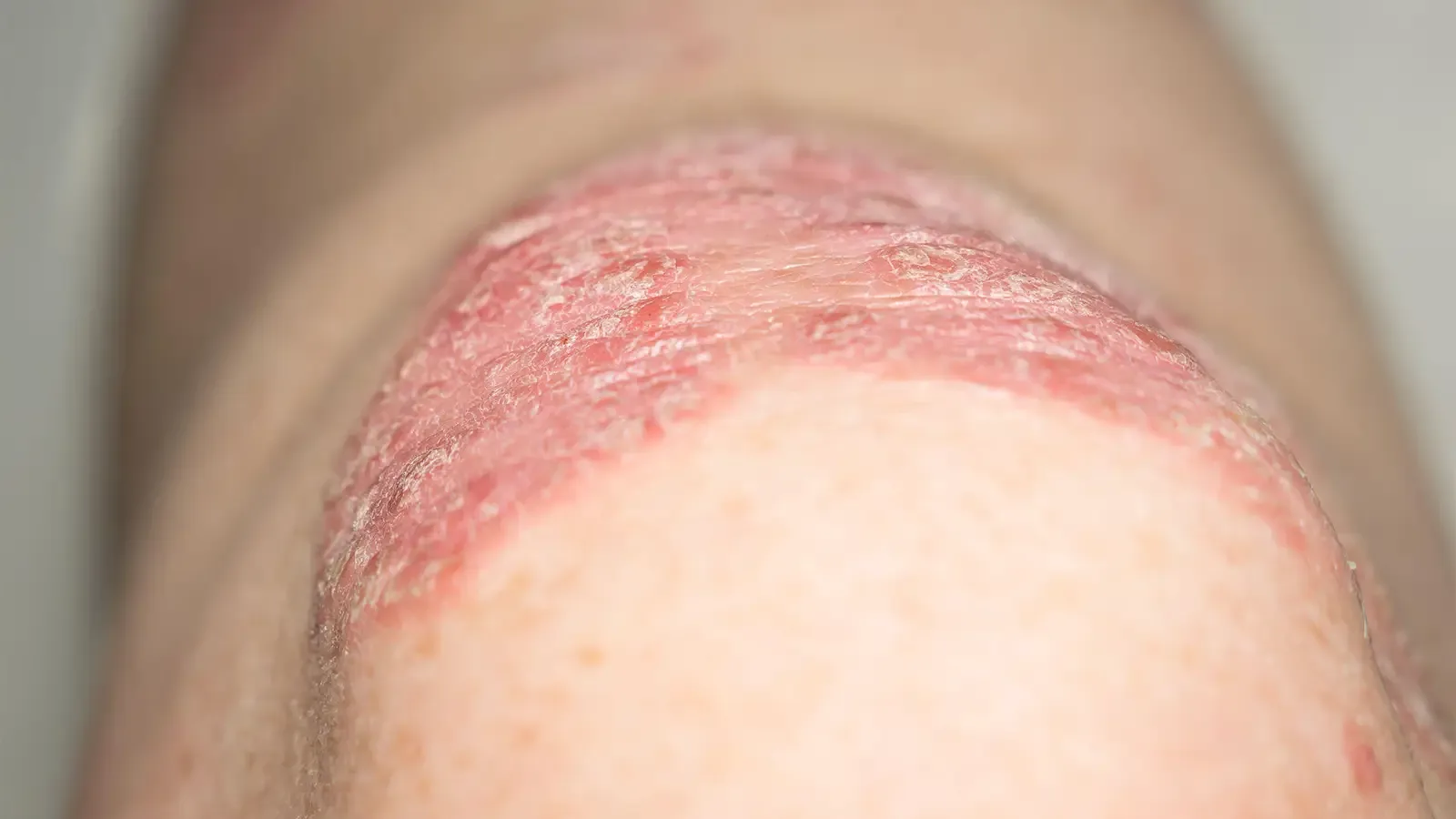 GLP-1 Agonists for Psoriasis: New Hope for Weight & Inflammation