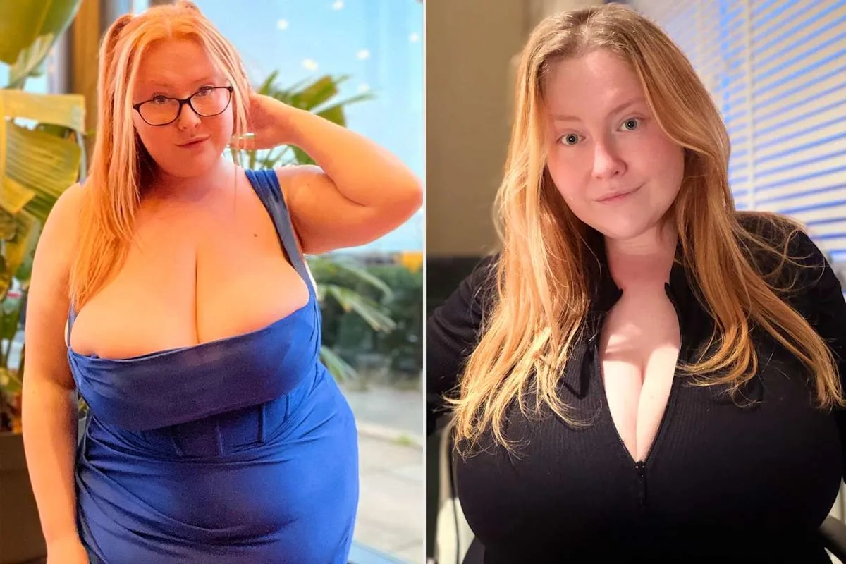 Woman's 39-lb Breasts Won't Stop Growing: Gigantomastia Discovered on Mounjaro
