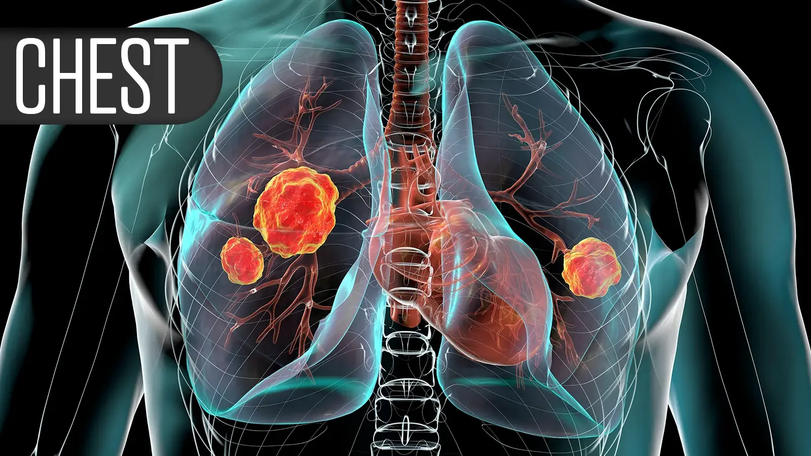 Estimulación del Nervio Hipogloso: Nueva Esperanza para Apnea del Sueño