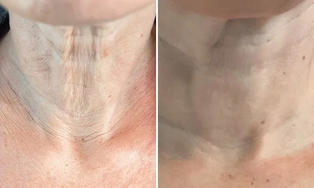 Naprawa obwisłej skóry i przerzedzonych włosów po 10 kg na Ozempic