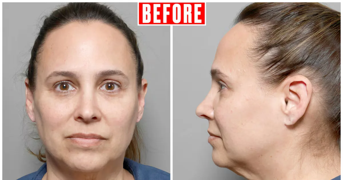 Beyond 'Ozempic Face': Navigating Skin Changes After Weight Loss