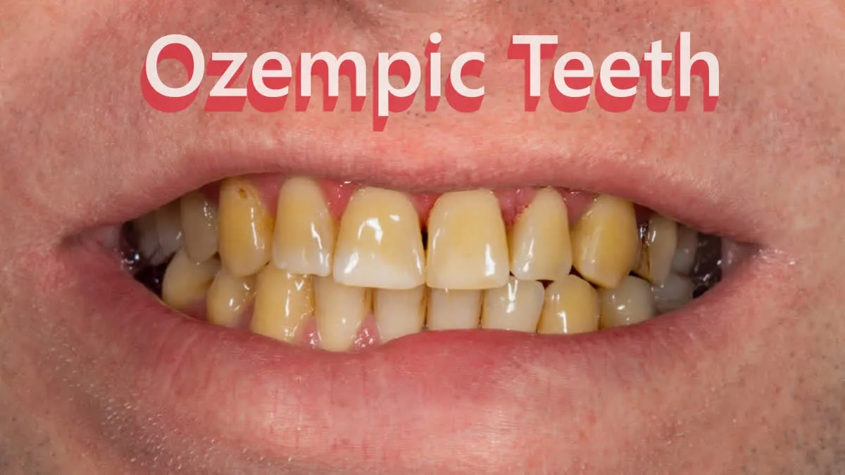 'Dientes de Ozempic': Dentistas alertan sobre riesgos orales de fármacos para bajar de peso